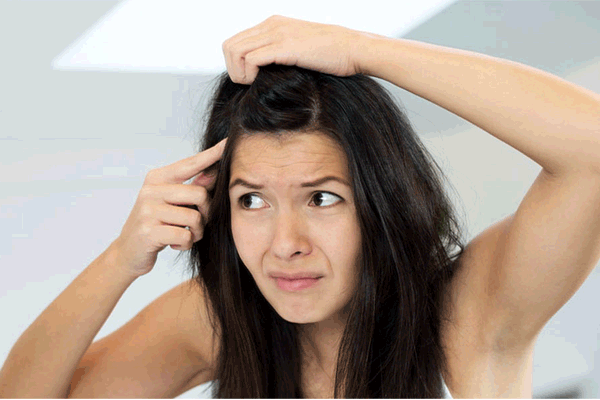 Go organic to beat dandruff