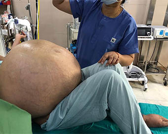 50 kg ovarian tumour removed from Delhi woman