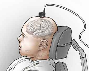 Brain implant turns paralysed man