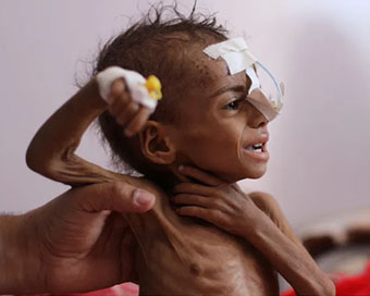 A nurse holds a malnourished girl at al-Sabeen Hospital in Sanaa, Yemen