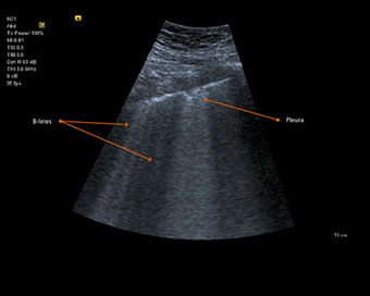 Lung ultrasound (file photo)