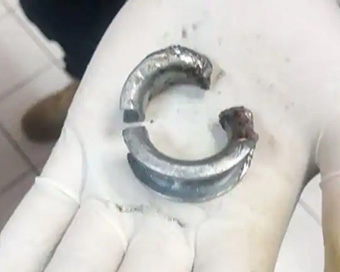 Man rushed to hospital after he put ring on penis to make it bigger to impress girlfriend on Valentine