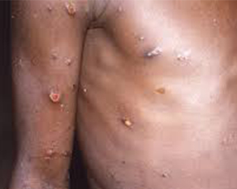 Suspected monkeypox patient in Andhra tests negative