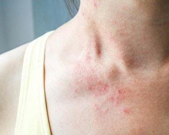 Study links skin rashes to Covid