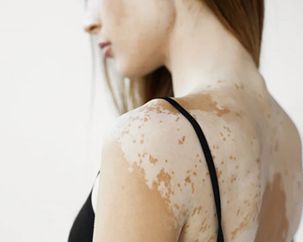 How to detect Vitiligo? Signs people should look out for
